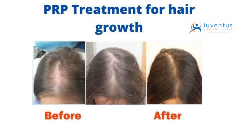 Benefit from PRP Treatment