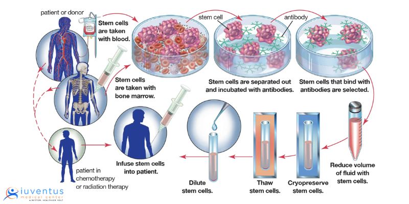 What Do You Mean By Stem Cell Therapy