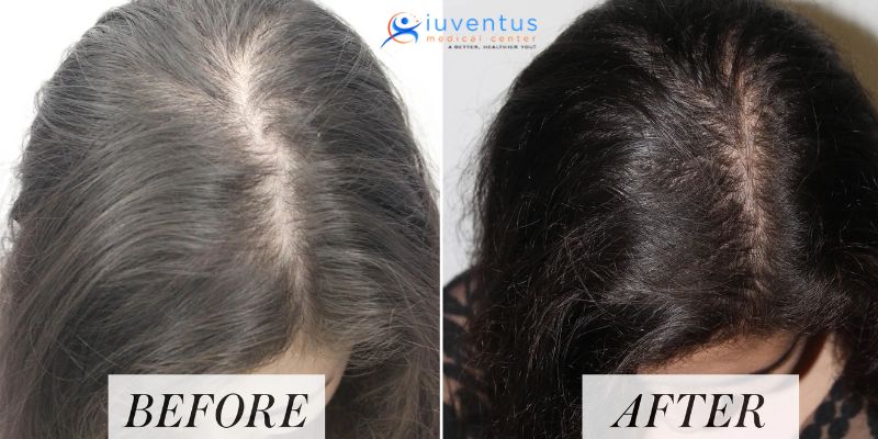 prp therapy for hairfall
