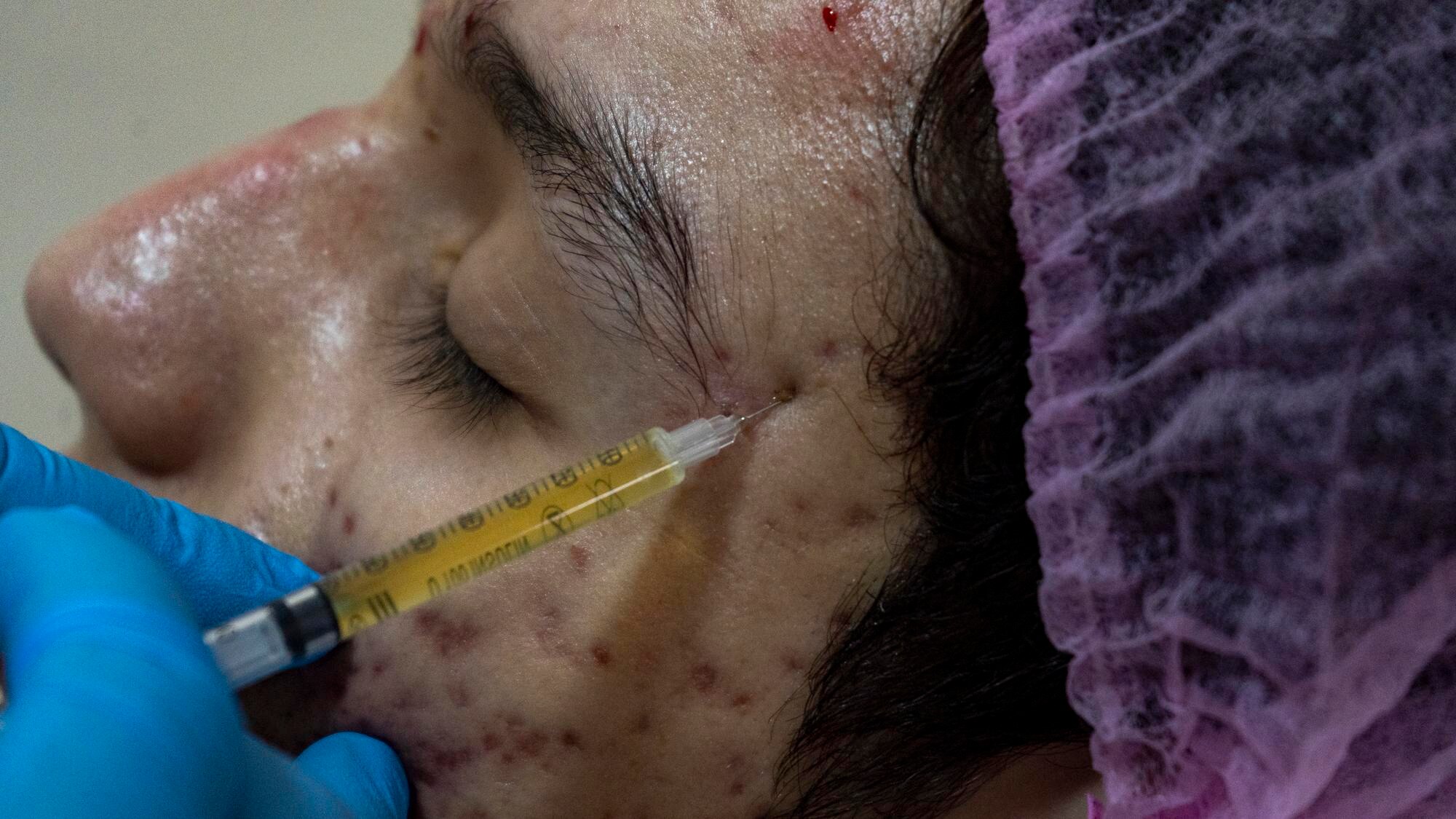 Unveiling the Dual Wonders of PRP Therapy